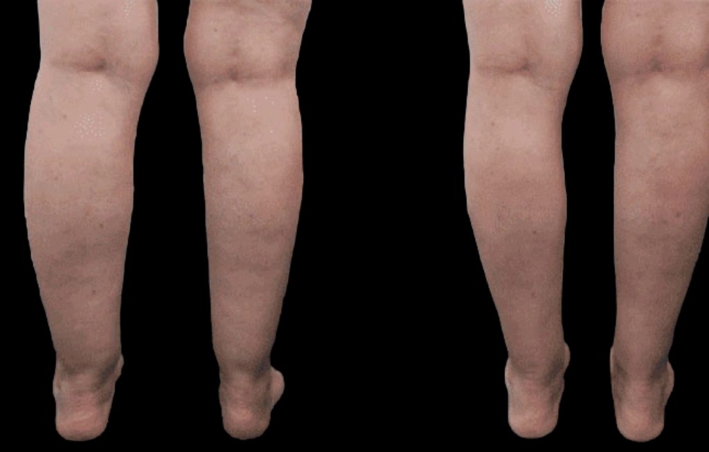 H6 Calf Liposuction - Perfect Doctors Clinic | Aesthetic & Plastic Surgery Clinic in Dubai Calf Liposuction Before and After Images in Dubai